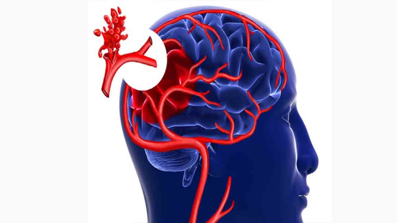 Beyin Anevrizması ve Anjiografik Tedavisi