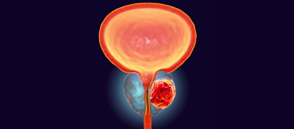 Prostat Embolizasyonu Mu Prostat Ameliyati Mi