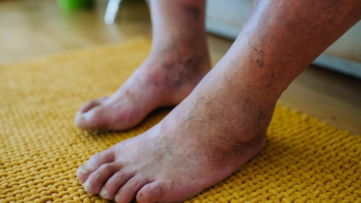 Diyabetik Ayak ve Kronik Ayak Yaralari Nasil Tedavi Edilir